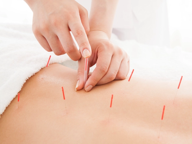 東洋医学鍼灸治療